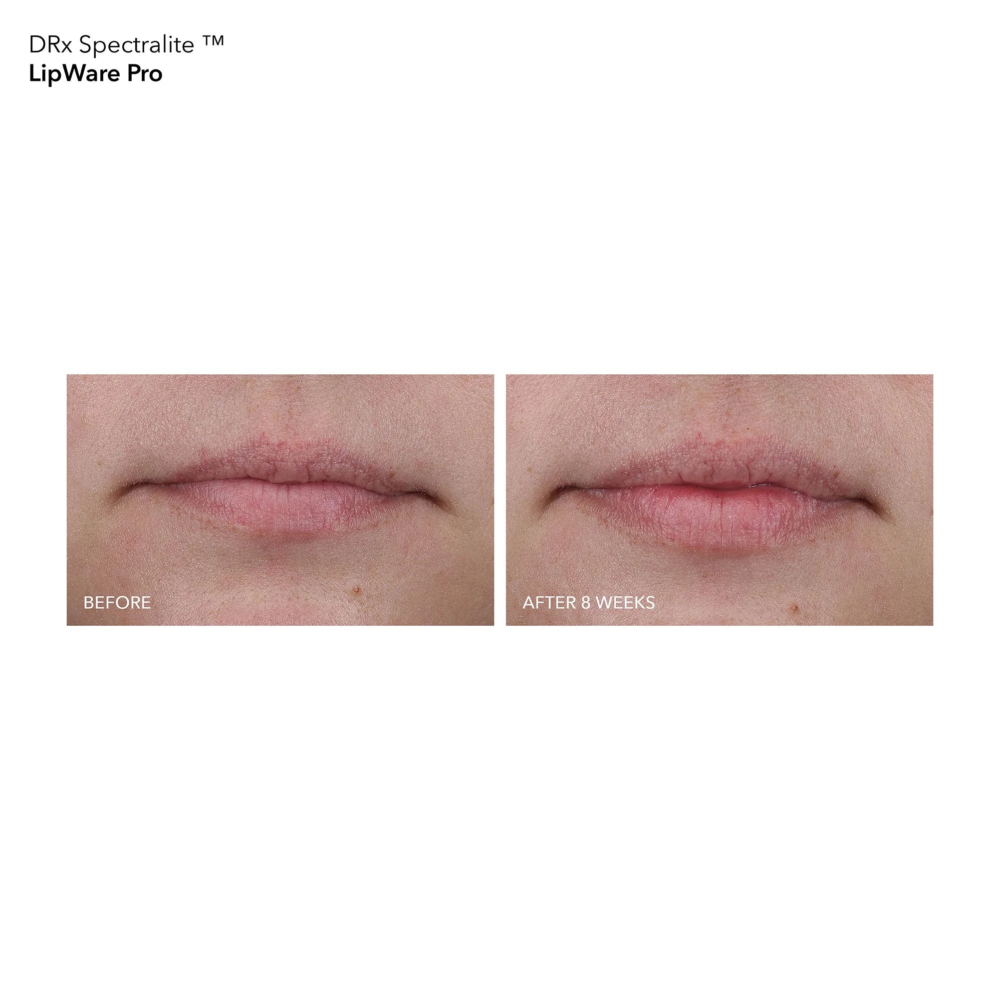 DRx SpectraLite LipWare Pro