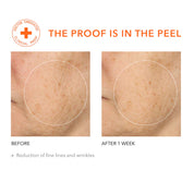 alpha-beta-universal-face-peel-dr-dennis-gross