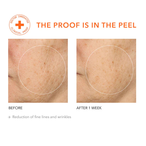 alpha-beta-universal-face-peel-dr-dennis-gross