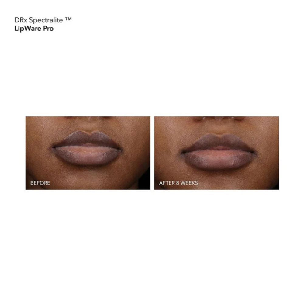 DRx SpectraLite LipWare Pro