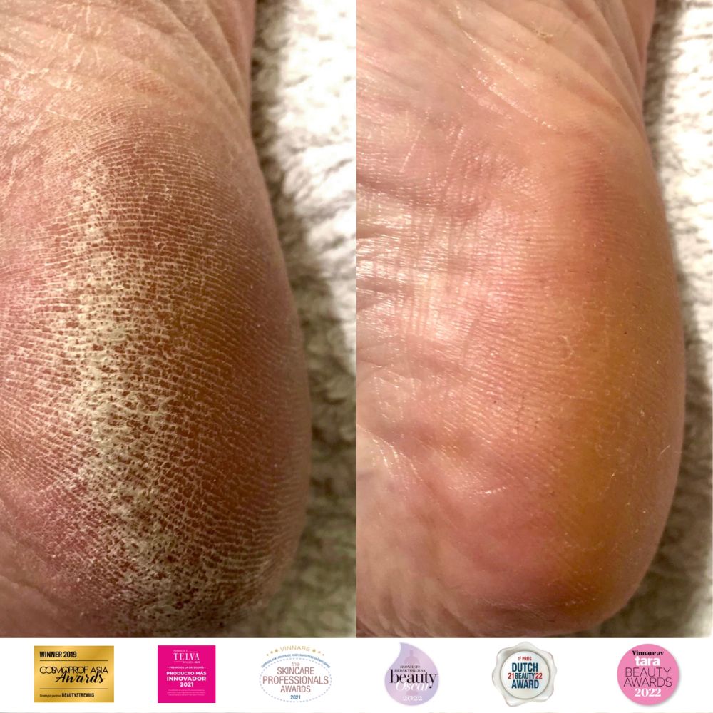 Instant Foot Peeling Spray