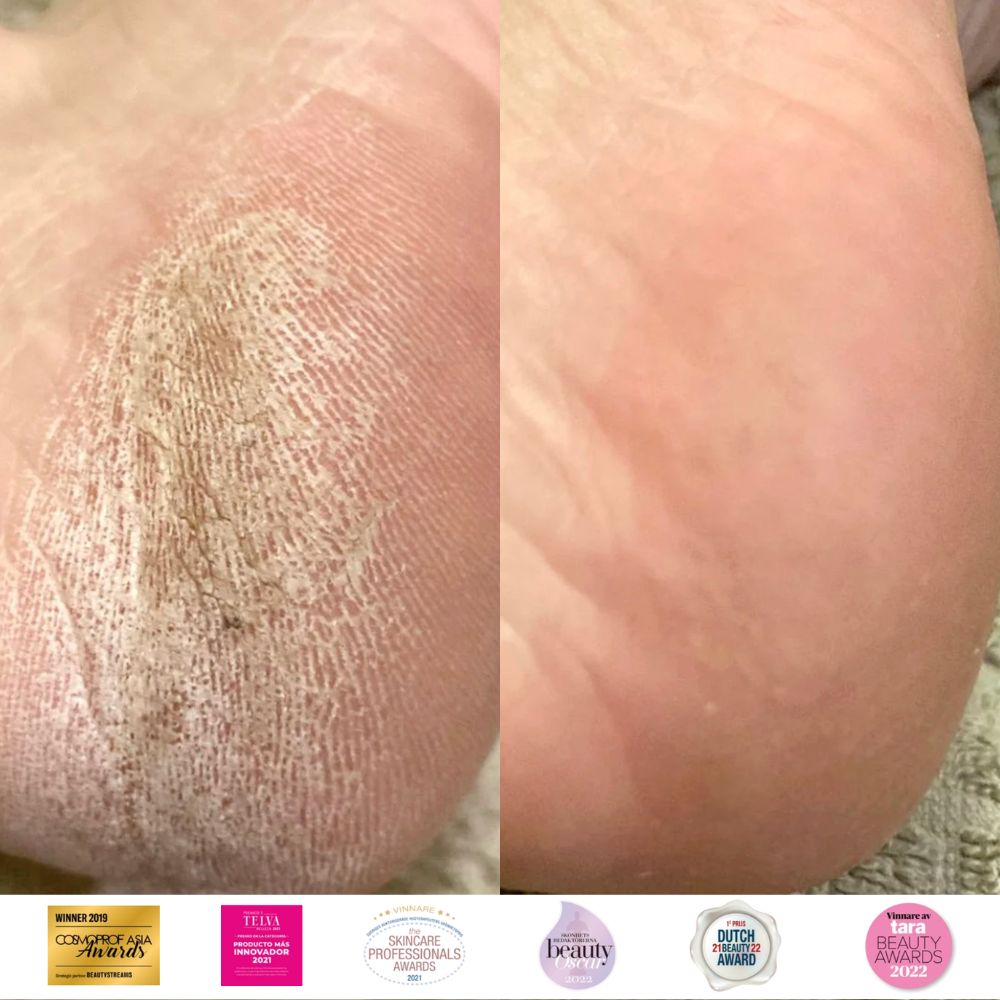 Instant Foot Peeling Kit