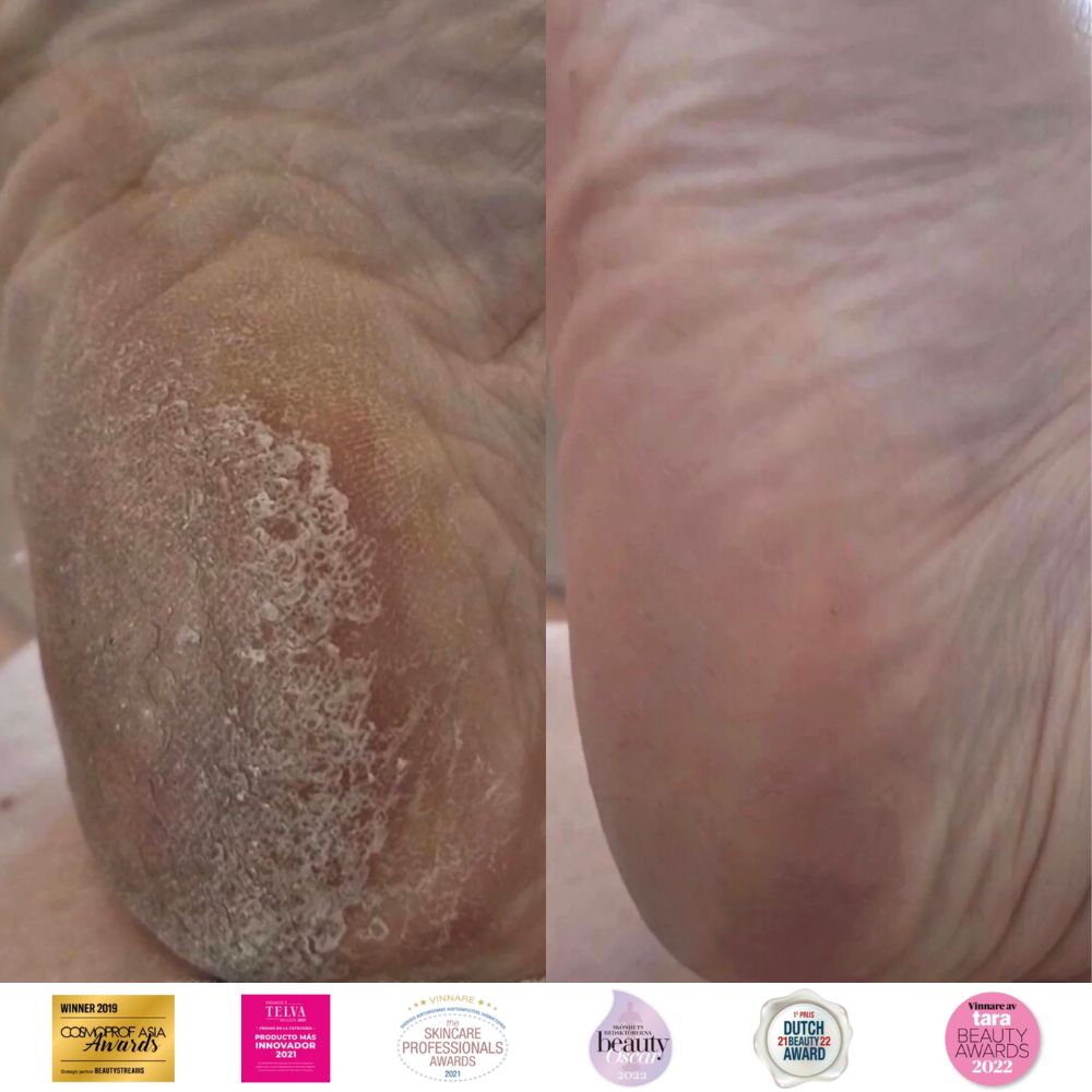 Instant Foot Peeling Kit