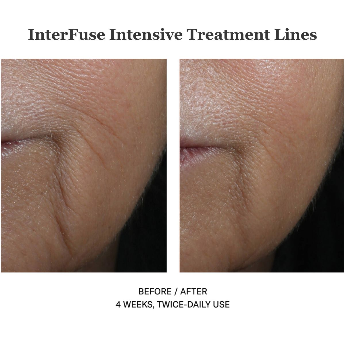 Interfuse Intensive Treatment Lines 15ml