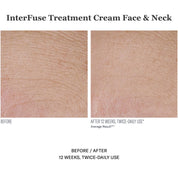 InterFuse Treatment Cream Face & Neck 30ml