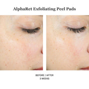 Alpharet Exfoliating Peel Pads 30stk