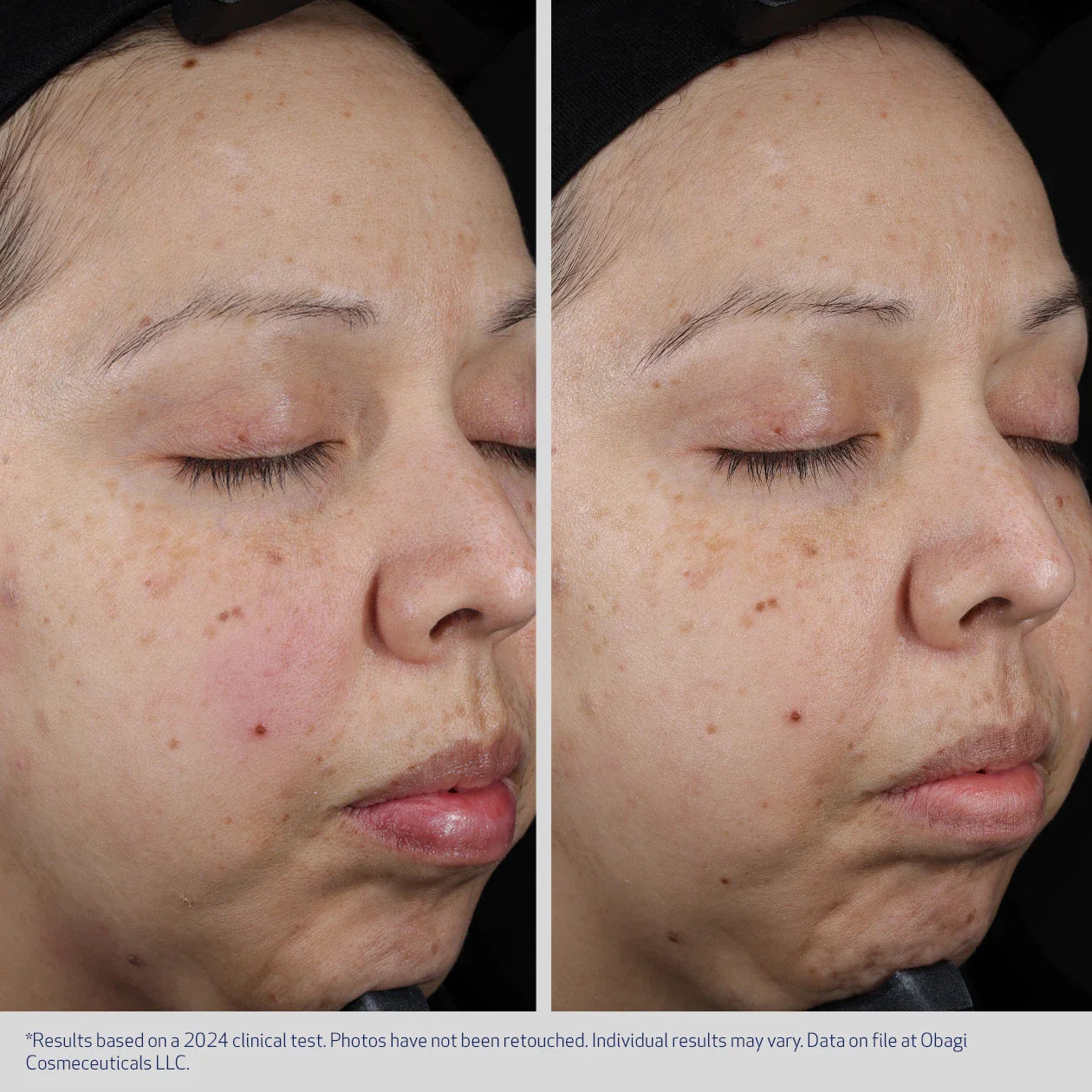 SUZANOBAGIMD Moisture Restore Hydration Cream fra Obagi Medical  før og etter