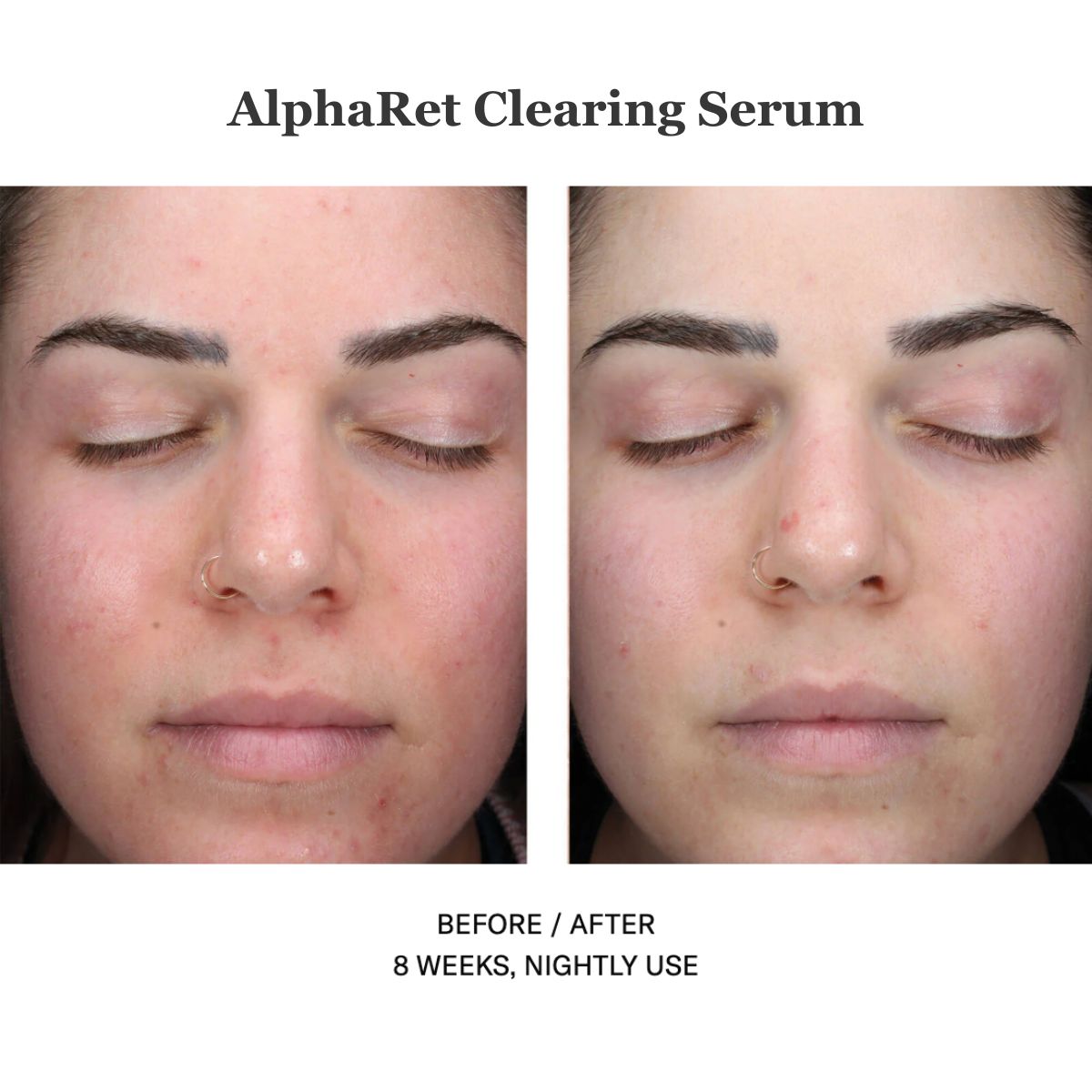 Alpharet Clearing Serum 30ml