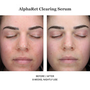 Alpharet Clearing Serum 30ml