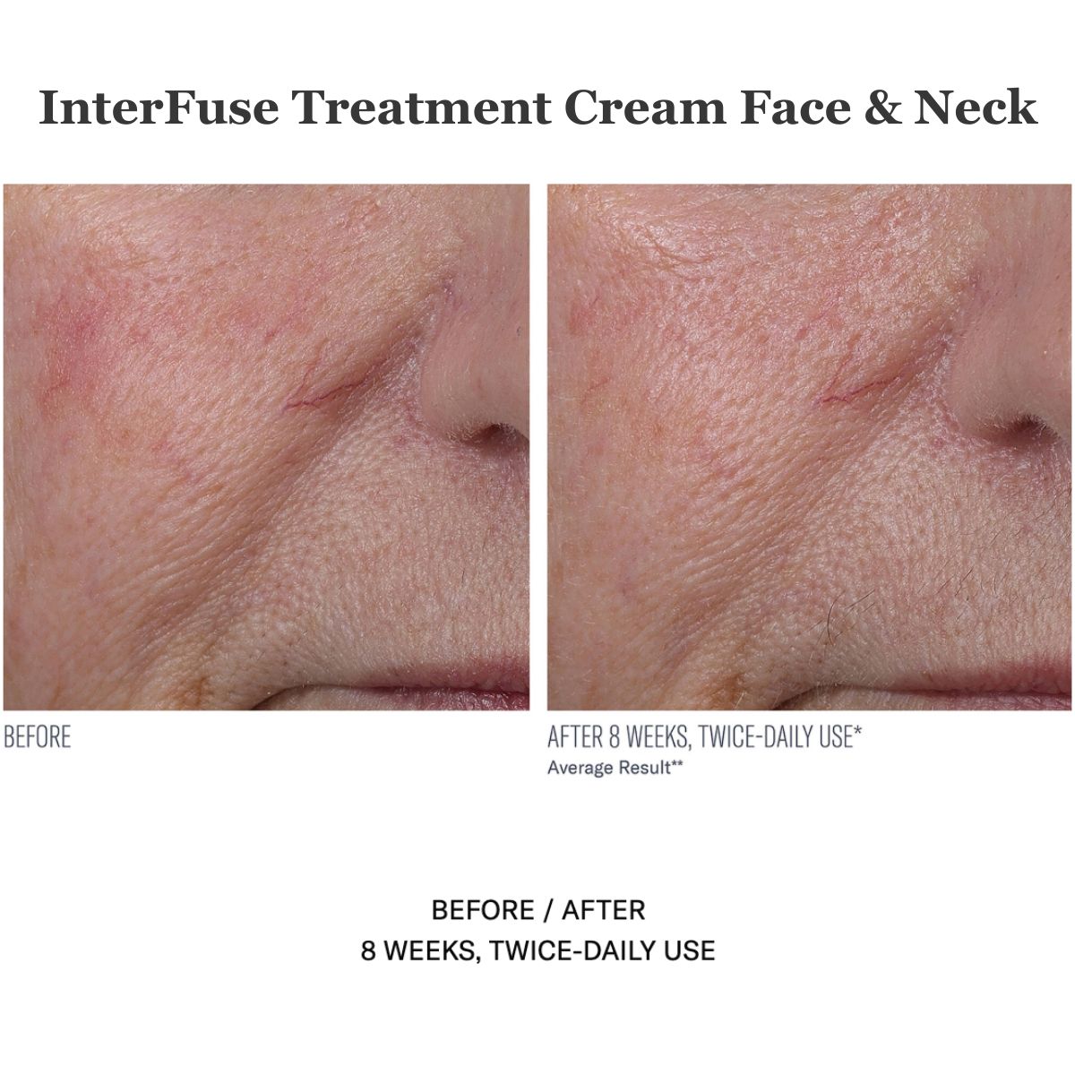 InterFuse Treatment Cream Face & Neck 30ml