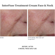 InterFuse Treatment Cream Face & Neck 30ml