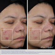 SUZANOBAGIMD Super Antioxidant Serum fra Obagi Medical før og etter
