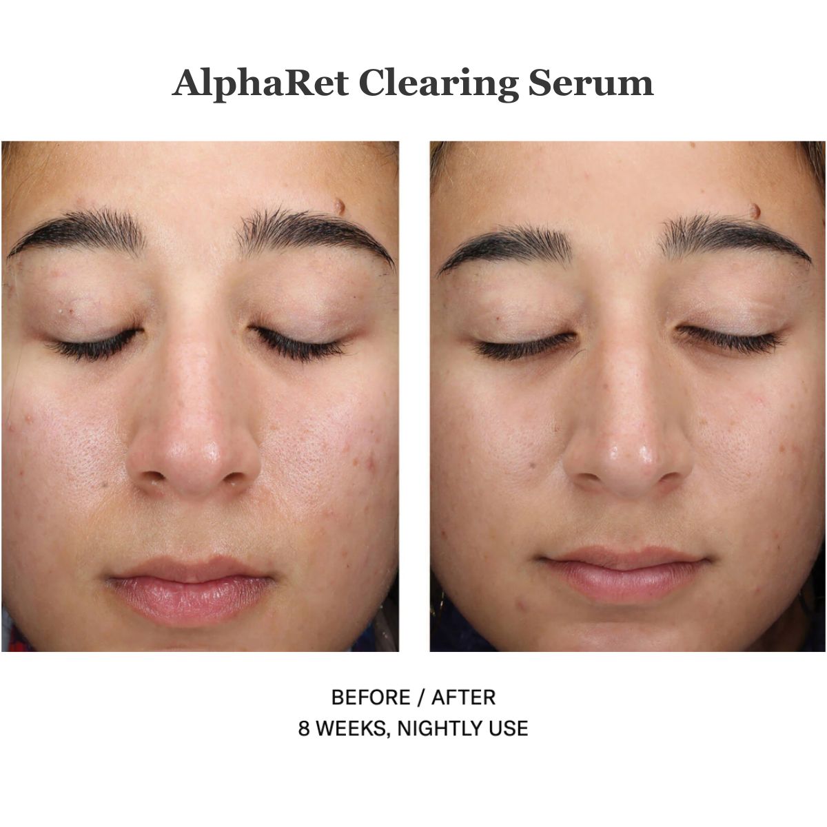Alpharet Clearing Serum 30ml