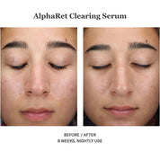 Alpharet Clearing Serum 30ml