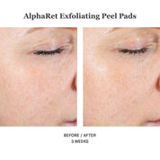 Alpharet Exfoliating Peel Pads 30stk