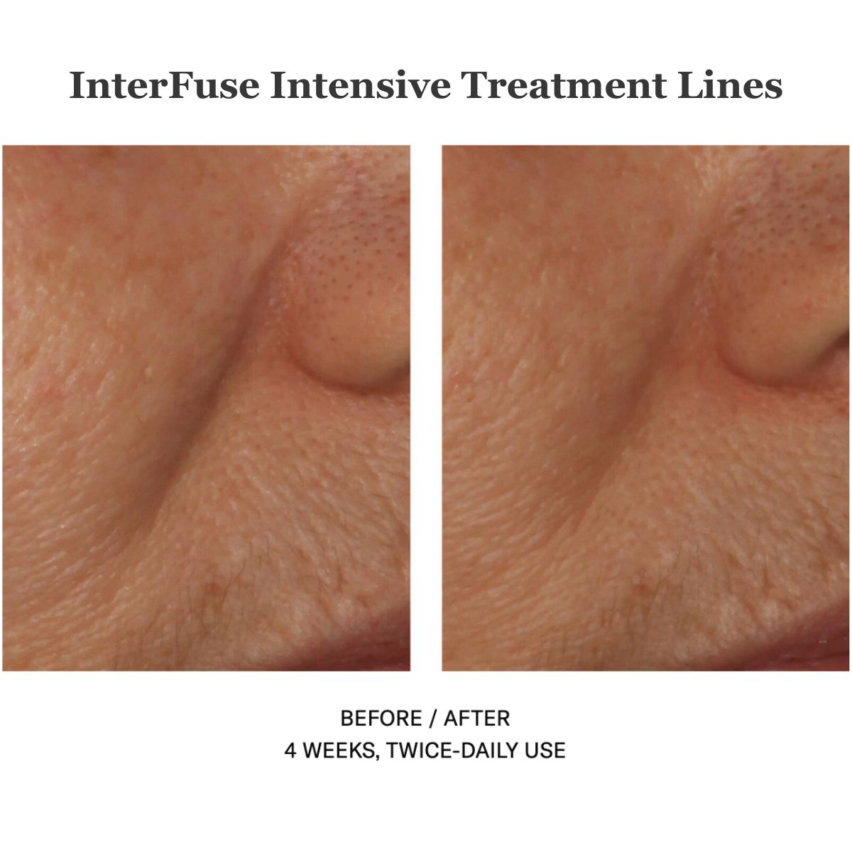 Interfuse Intensive Treatment Lines 15ml