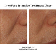 Interfuse Intensive Treatment Lines 15ml