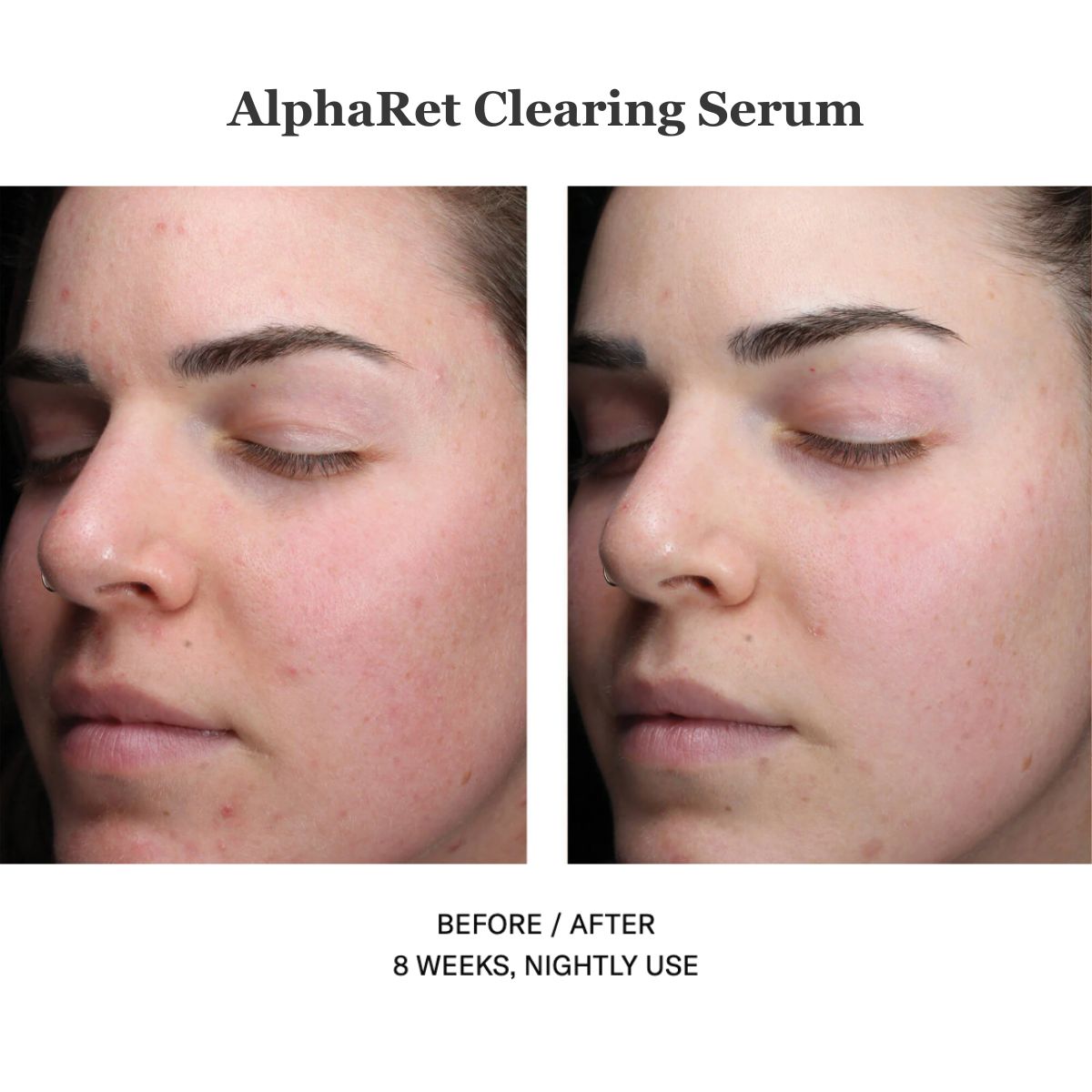 Alpharet Clearing Serum 30ml