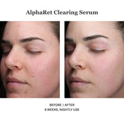 Alpharet Clearing Serum 30ml