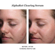 Alpharet Clearing Serum 30ml