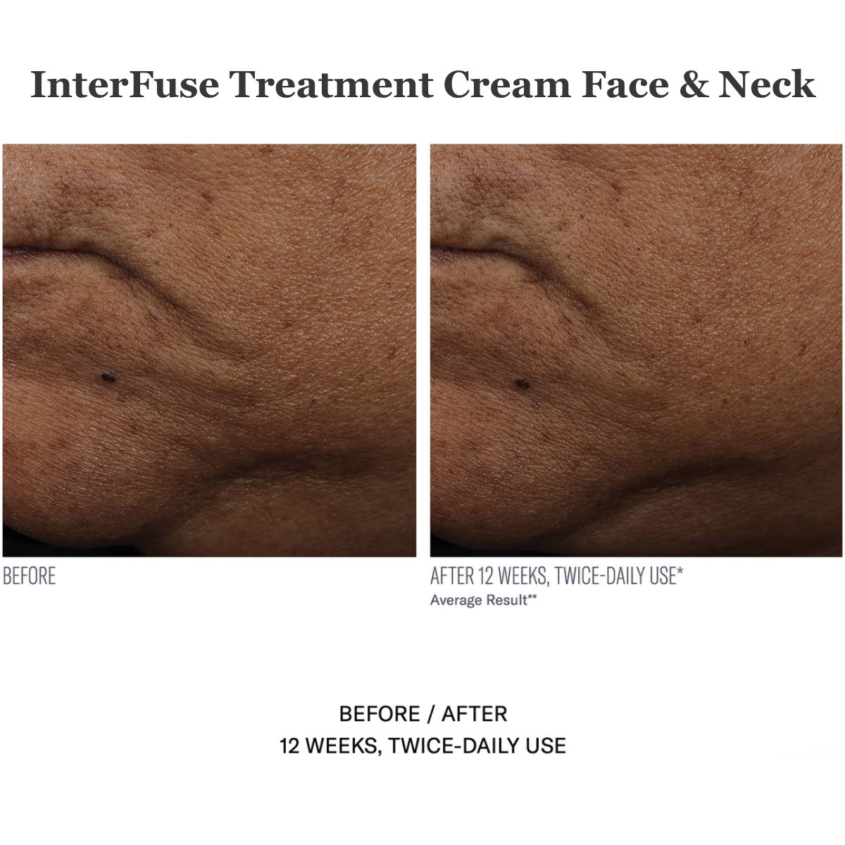 InterFuse Treatment Cream Face & Neck 30ml