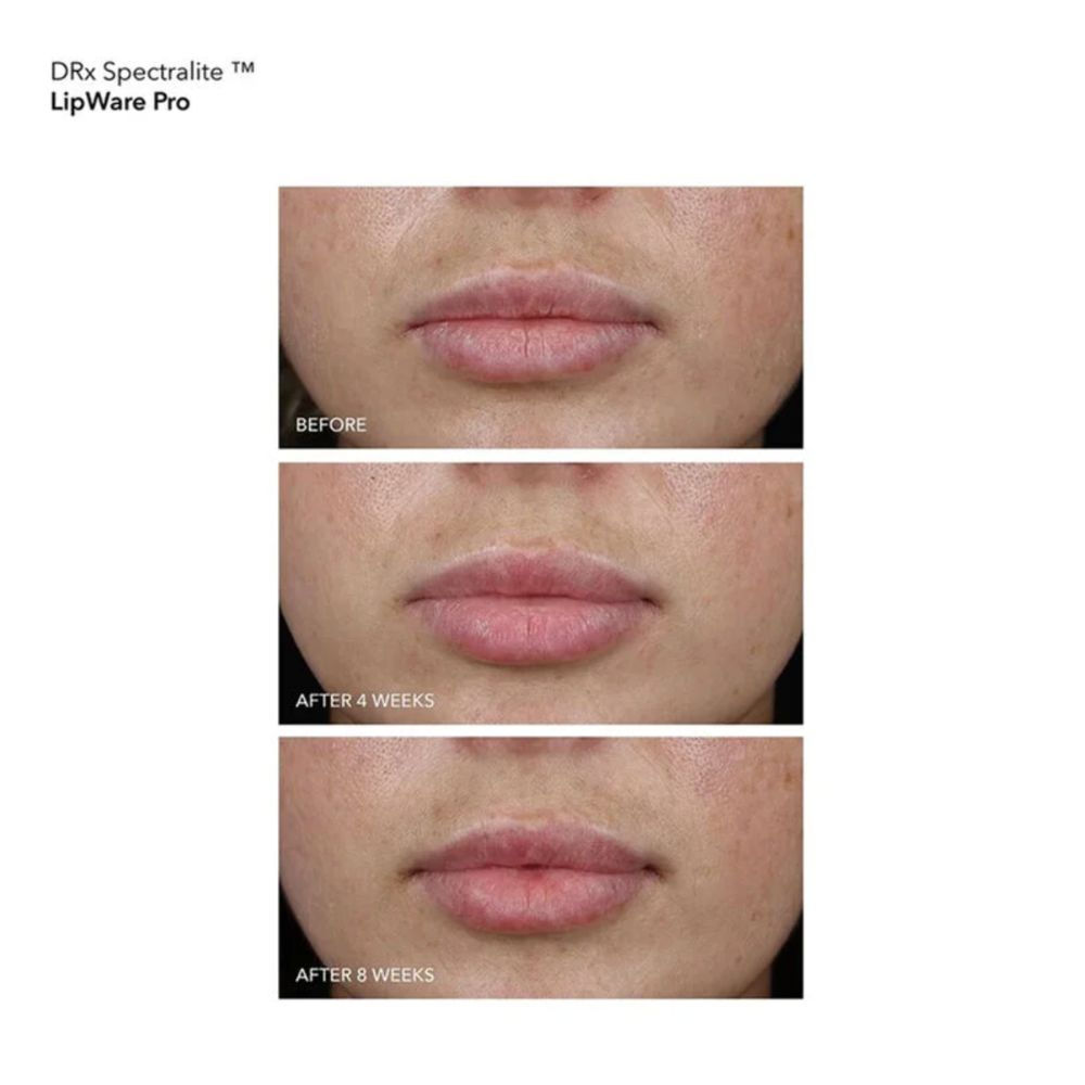 DRx SpectraLite LipWare Pro