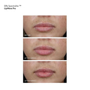 DRx SpectraLite LipWare Pro
