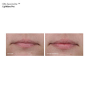 DRx SpectraLite LipWare Pro
